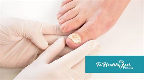 How Does A Foot Doctor Treat Toenail Fungus Manhattan Podiatrist