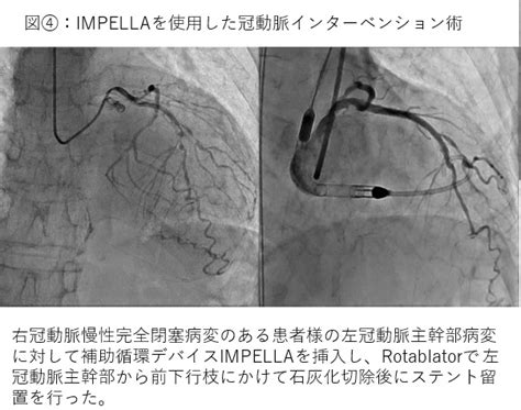 熊本大学病院 循環器内科 冠動脈疾患・末梢動脈疾患に対する最新の治療