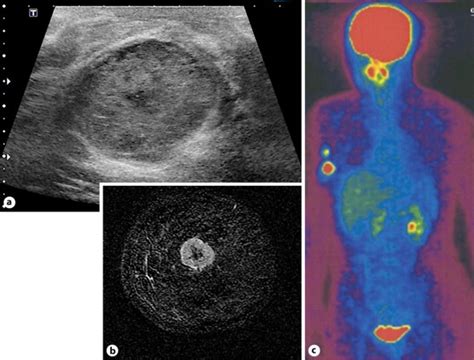 a Breast ultrasound examination. A well-defined, smooth-surfaced, hypo-... | Download Scientific ...