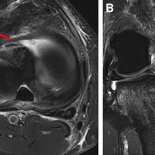 (A) Axial MRI image of a right knee demonstrating a radial tear of the ...