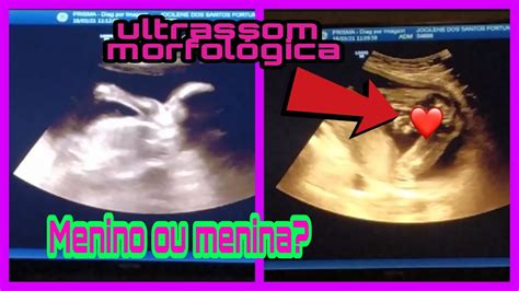 Ultrassom morfológica menino ou menina 22 semanas YouTube