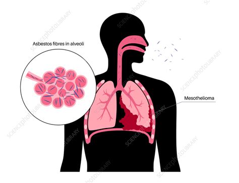 Mesothelioma Cancer Disease Illustration Stock Image F041 9632