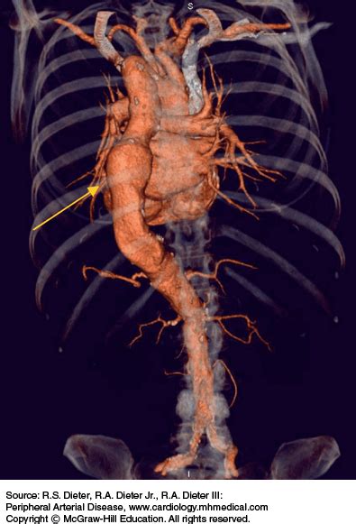 Peripheral Angiography Thoracic Key