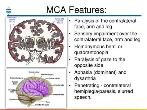 Symptoms And Symptoms Of Left Mca Stroke