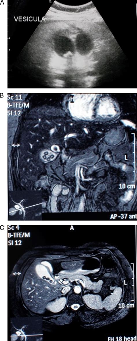 Gallbladder Duplication And Cholecystitis Pmc