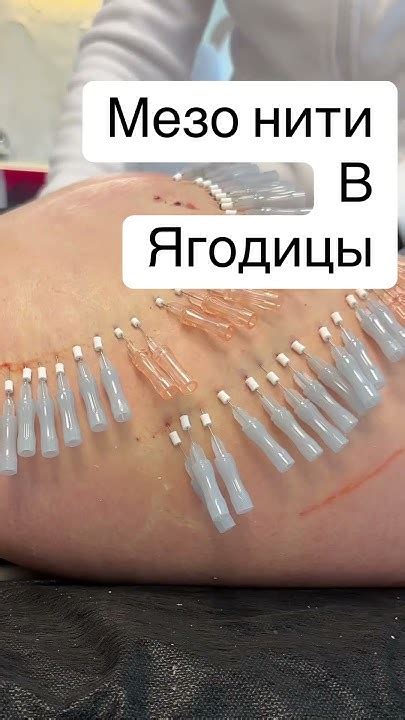 #филлеры и мезо нити в ягодицы - YouTube