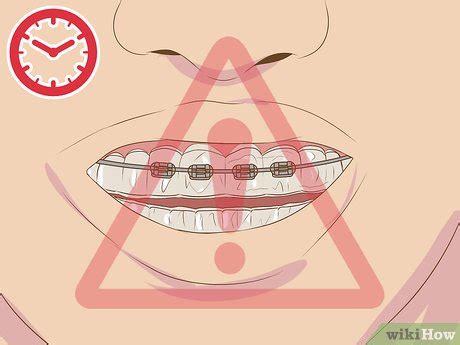 How To Make Fake Braces Retainers A Tutorial