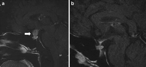 Sagittal Contrast Enhanced T1 Weighted Mri Of Case 1 Father Showing A