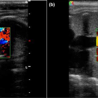 Colour Doppler Ultrasonography Of The Fetal Heart A And Fetal Aorta