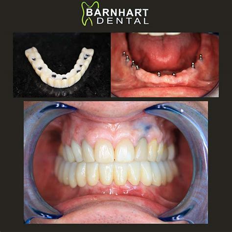 Mini Dental Implant Supported Denture