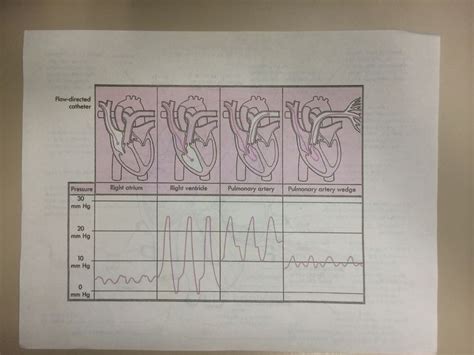 PA pressure waveforms and swan ganz | Respiratory therapy, Icu, Nursing ...