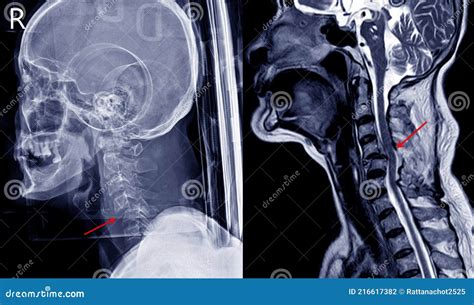 Mri Cervical Spine Fracture