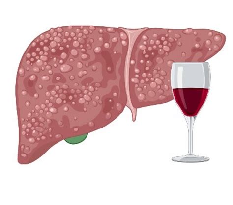 Alcohol Liver Disease Gastroenterology Hepatology Stanford Medicine