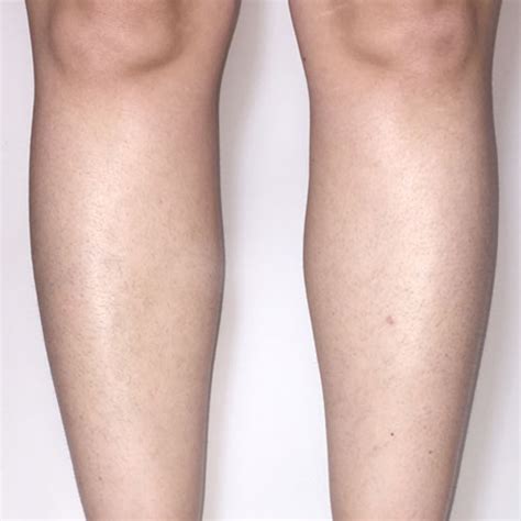 Venus Velocity Laser Hair Removal Venus Treatments Usa