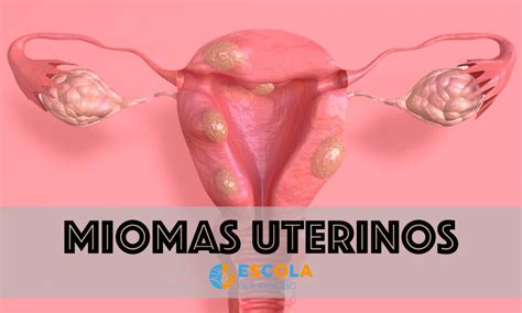 Mioma uterino O que são causas sintomas tipos tratamento