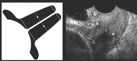 Ultrasound Evaluation Of The Cervix Radiology Key