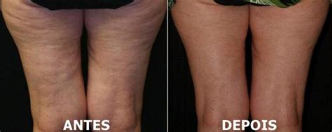 Celulite Antes E Depois - Poderosa receita caseira para combater a celulite: usa apenas 2 ...