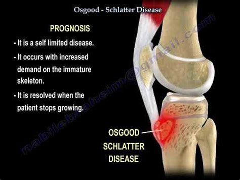 Osgood Schlatter Disease • Video •