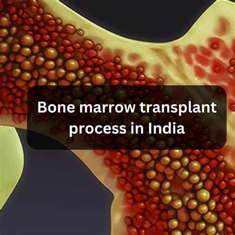 Bone Marrow Transplant In India Know The Best Hospitals Doctors