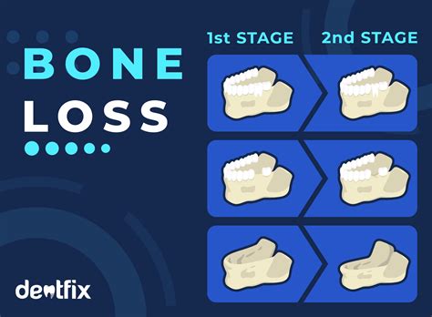 Bone Loss In Teeth Signs And Causes Dentfix