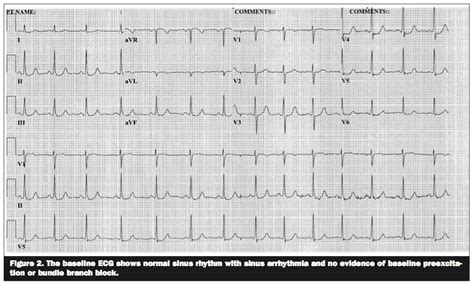 Wide Complex Tachycardias Demystifying The Differential Diagnosis