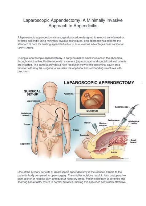 PPT Laparoscopic Appendectomy A Minimally Invasive Approach To