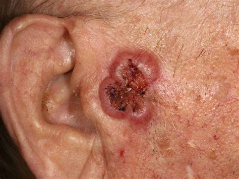 Squamous And Basal Cell Carcinoma Surgical Margins