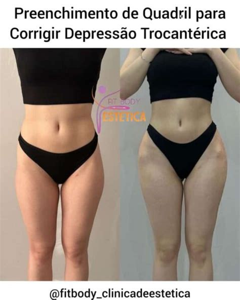 Preenchimento De Quadril Para Corrigir Depress O Trocant Rica Cl Nica