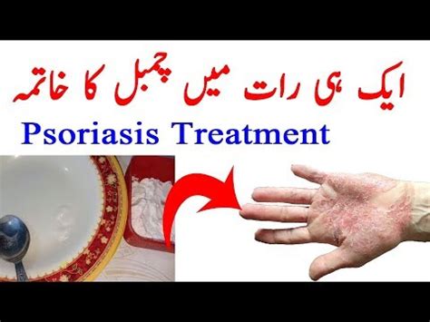 Psoriasis Treatment Chambal Ka Ilaj YouTube