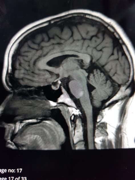 Pituitary Gland Tumor? : r/askneurology