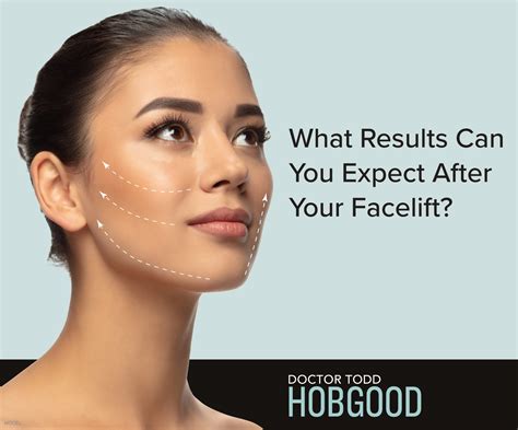 Facelift Before And After Photos What Real Results Look Like Updated