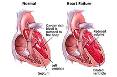 Cardiac Failure