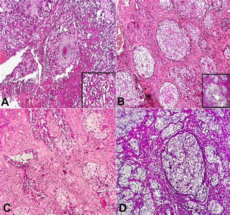 Scielo Brasil Acantholytic Oral Squamous Cell Carcinoma With Clear