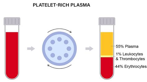 Platelet Rich Fibrin Prf Vedas Med Spa Wellness Center