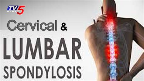 Lumbar Spondylosis Treatment