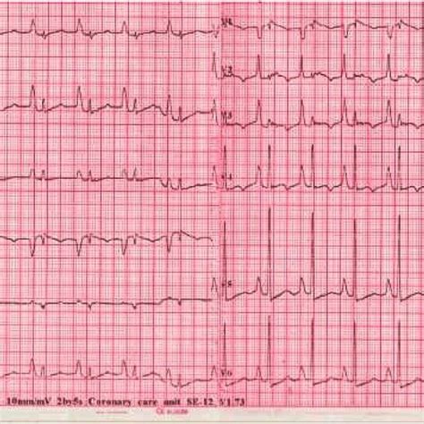 The 12 Leads ECG Showing Right Atrial Abnormality P Taller Than QRS In