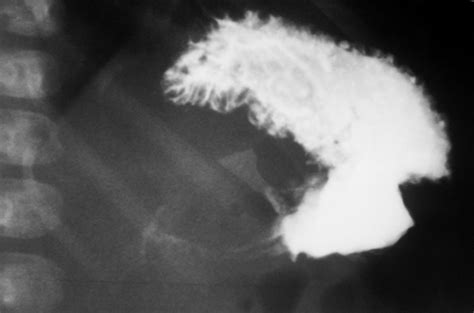 Hypertrophic Pyloric Stenosis Radiology Case