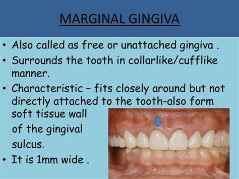 Clinical Features Of Gingiva