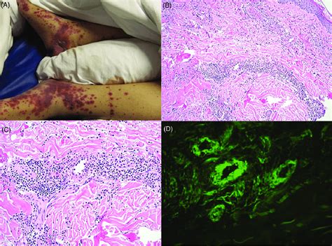 A Palpable Purpuric Rash Coalescent Into Plaques With Overlying Bulla Download Scientific