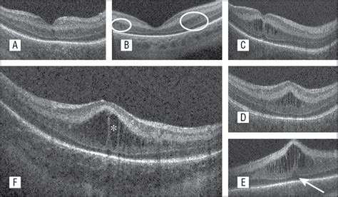 Cystoid Macular Edema Histology