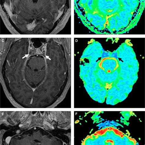 Focal pachymeningeal enhancement on initial gadolinium-enhanced MRI ...