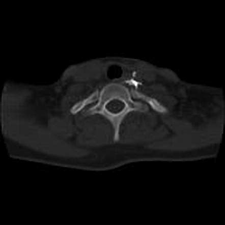 Stellate Ganglion Block Recovery