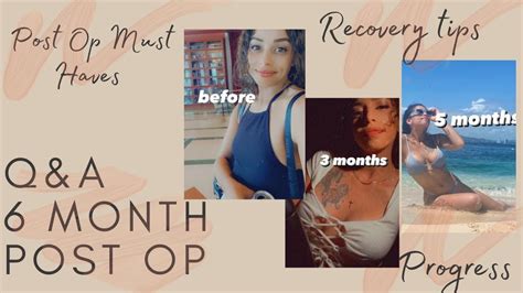 Breast Augmentation Q A Month Post Op Youtube