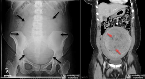 Learningradiology Uterine Fibroid Leiomyoma