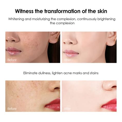 Powerful Whitening Cream Chinese Cream To Remove Freckles And Dark