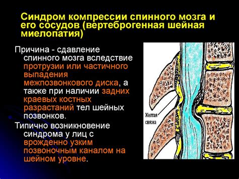 Вертеброгенная Цервикалгия Что Это Такое Картинки Telegraph