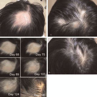 Sequential Images Of Patchy Hair Loss A A Hairless Cm Cm Patch