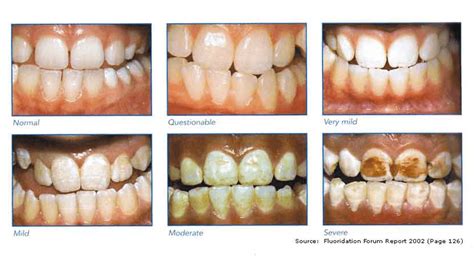 Fluoride Levels in Drinking Water Lowered Due to Health Risks