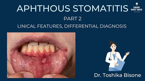 Recurrent Aphthous Stomatitis Part 2 Clinical Features