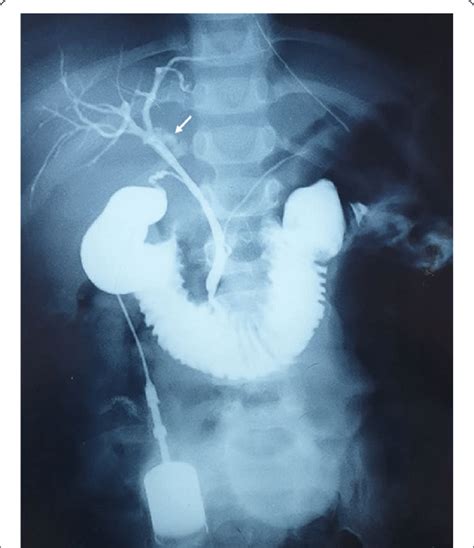 Intraoperative cholangiography showing the leak of contrast from the ...